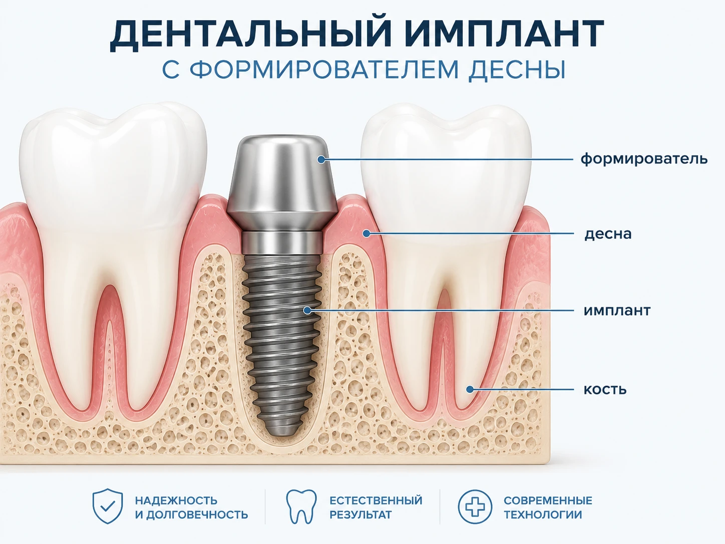 Схема одноэтапной имплантации с имплантом и формирователем десны