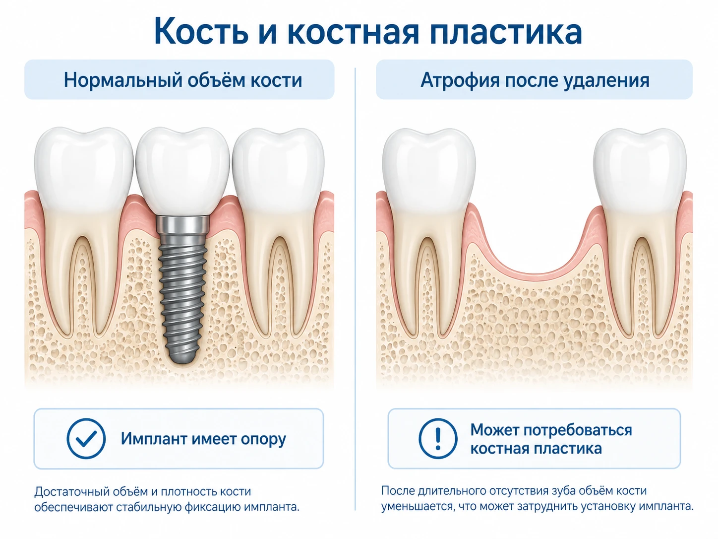 Схема нормального объёма кости и атрофии кости после удаления зуба