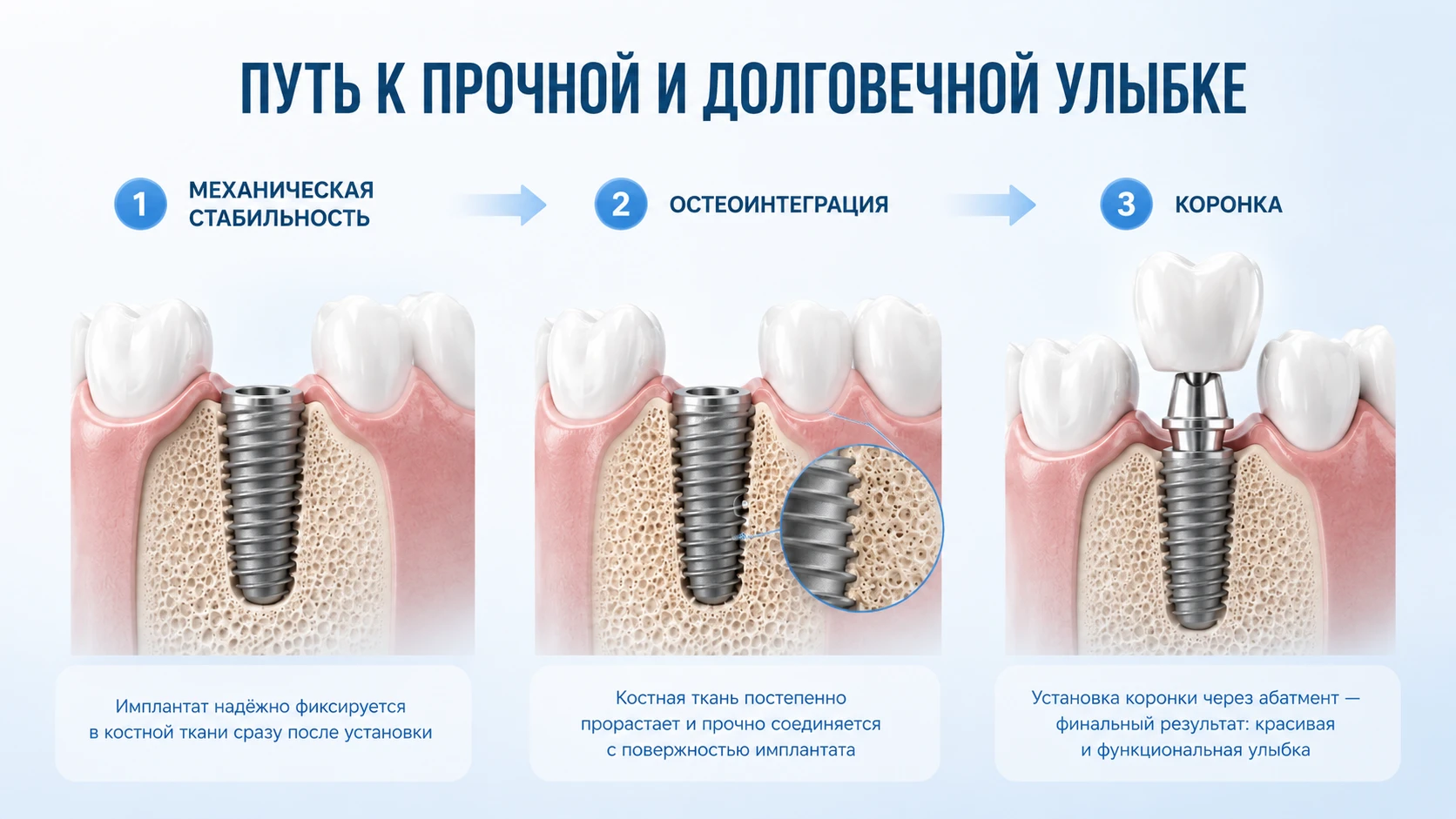 Схема этапов работы импланта: механическая стабильность, остеоинтеграция и установка коронки